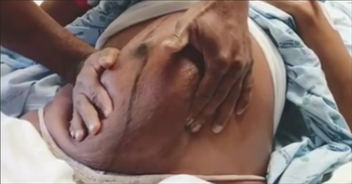 Arzt dreht Baby im Mutterleib, um Kaiserschnitt abzuwenden.	